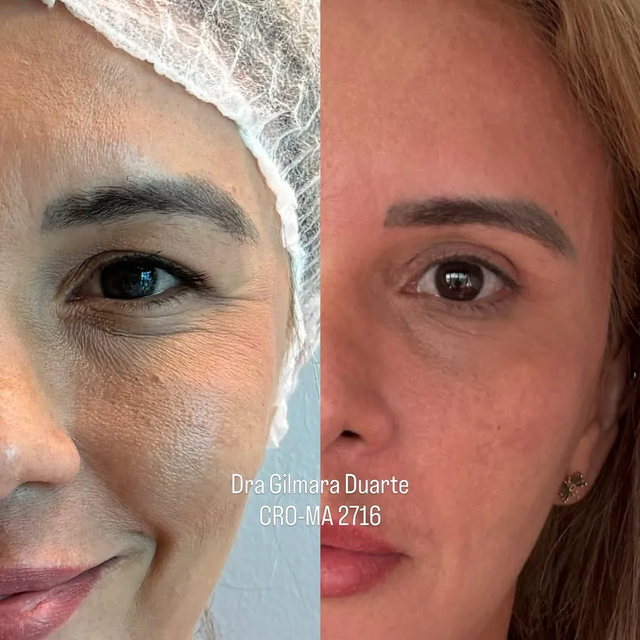 Olhar de paciente antes e seis meses depois